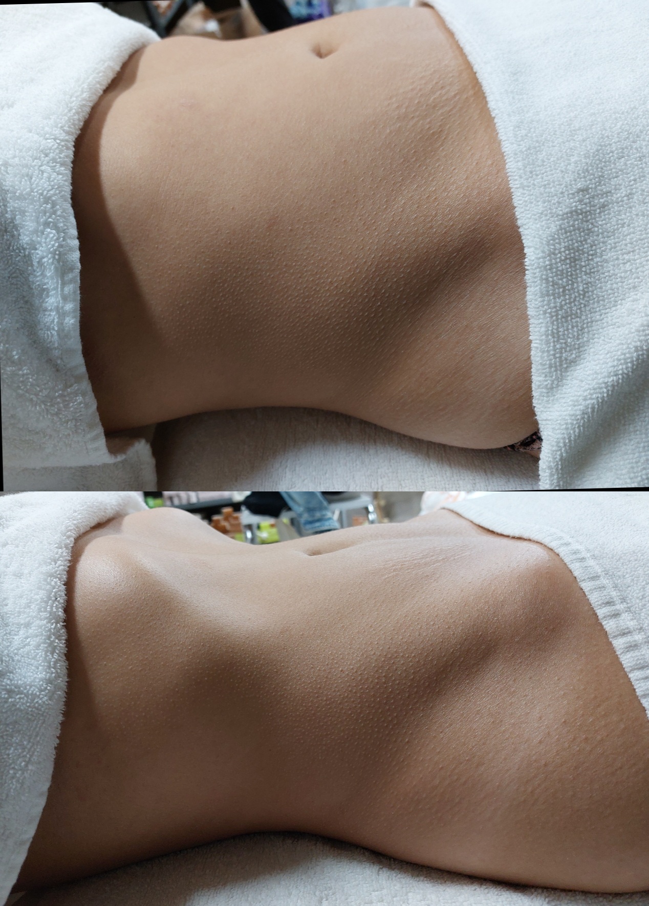 Resultados Método Abdomen